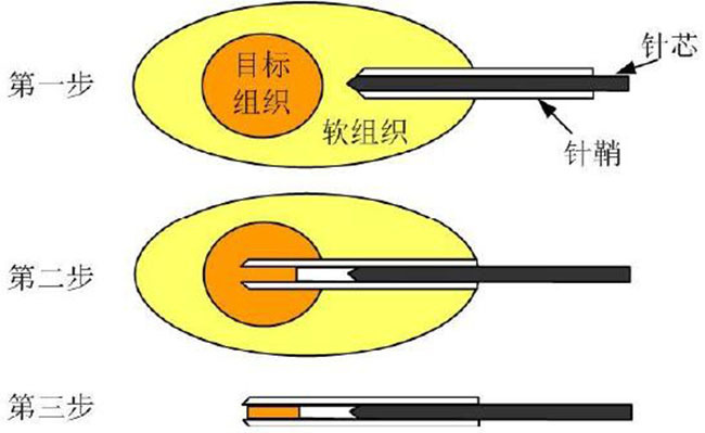 图2 活检针的取样步骤