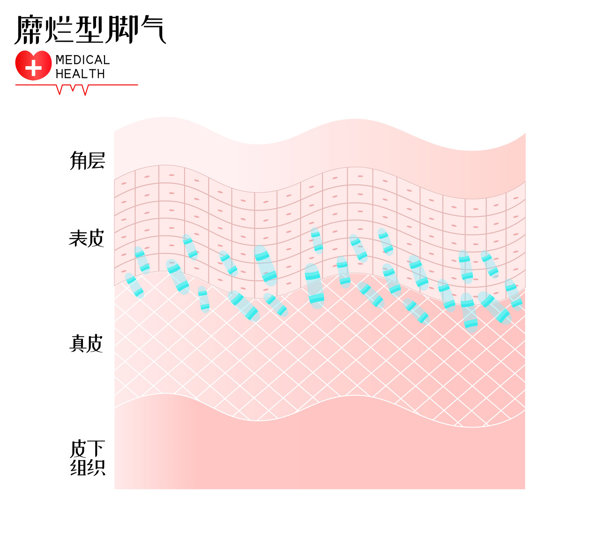 慢性炎症湿疣改变无病变