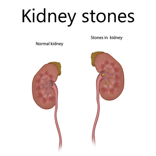 肾结石会导致阳痿早泄吗