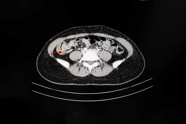 腹腔囊肿阴道出血吗