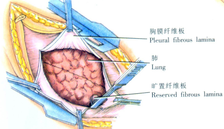 示意图4:切除剑突