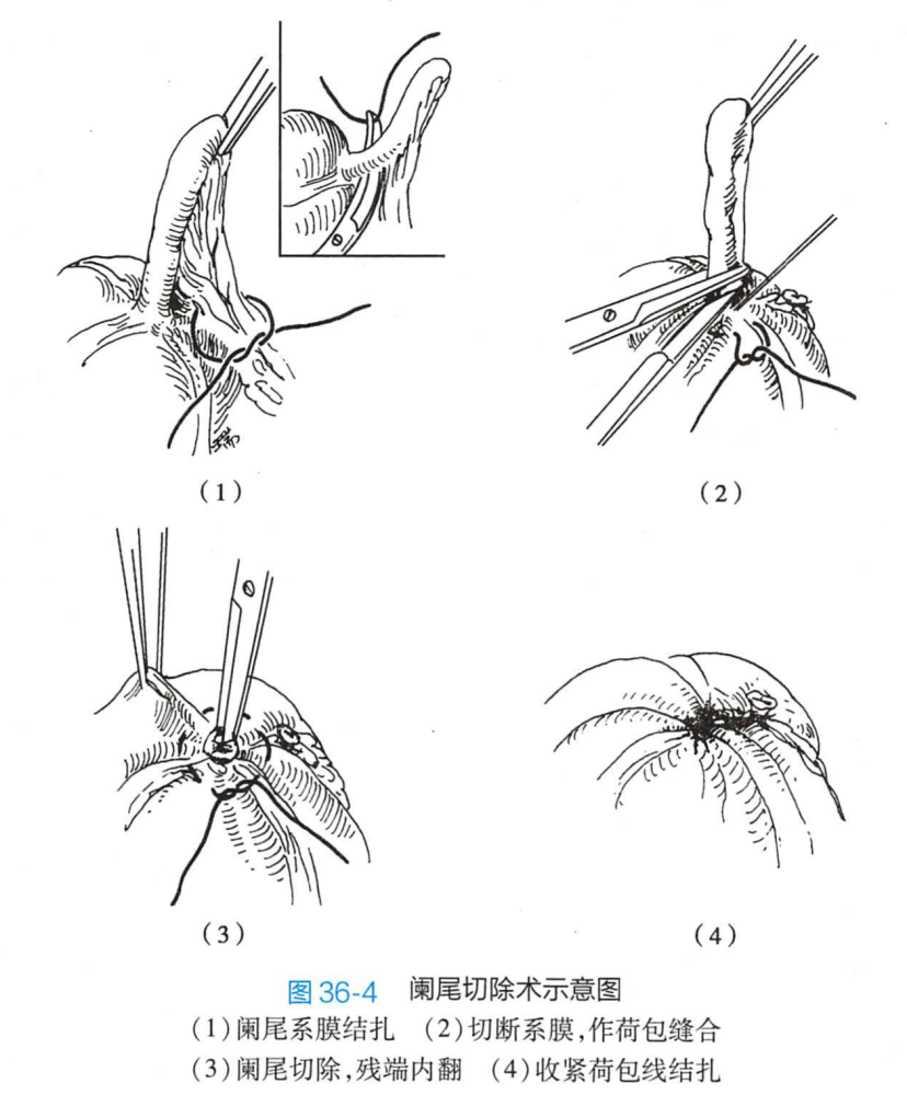 阑尾切除术示意图