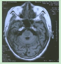 脑干梗死MRI表现：T1WI相